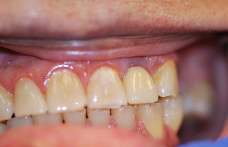 Dental-Implants-After-Image
