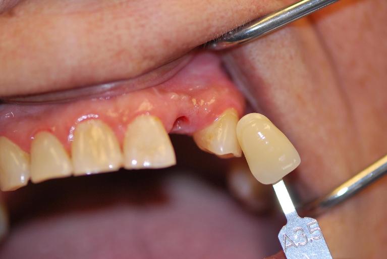 Dental-Implants-Before-Image